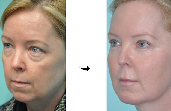 Blepharoplasty