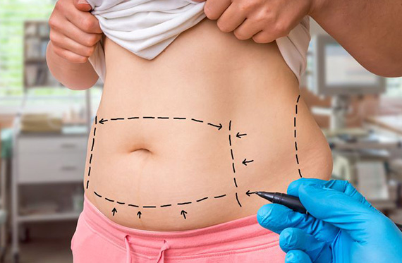 Liposuction